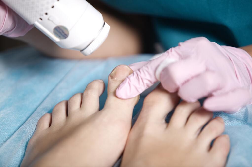 Pedicura médica nun podólogo por onicomicosis