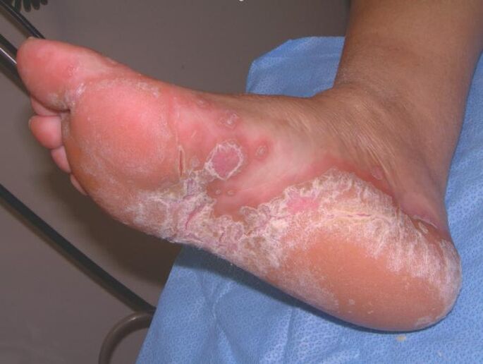 Un pé afectado por unha infección por fungos