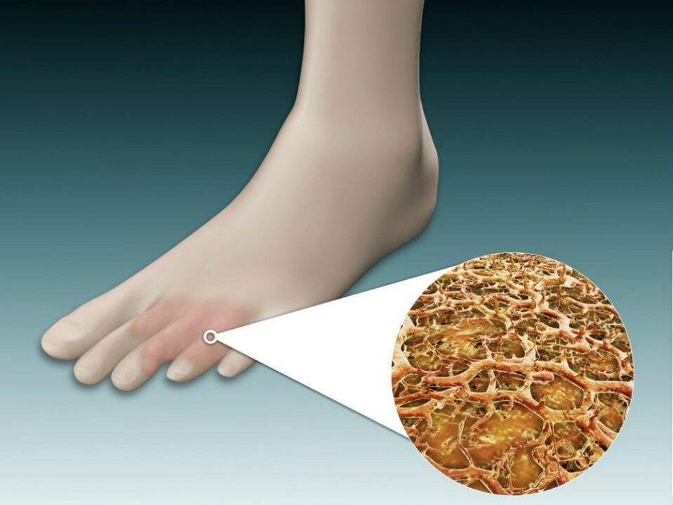 Infección fúngica nos pés
