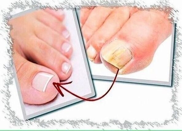 antes e despois do tratamento de fungos nas unhas dos pés