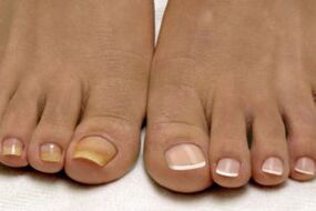 pés antes e despois do tratamento de fungos nas unhas