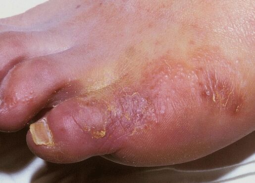 Un exemplo dunha infección fúngica do pé causada por Trichophyton interdigitale
