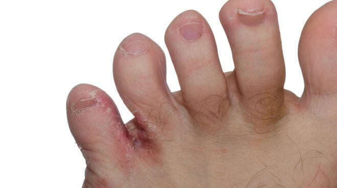 Sinais de fungo entre os dedos dos pés - rachaduras e descamación da pel
