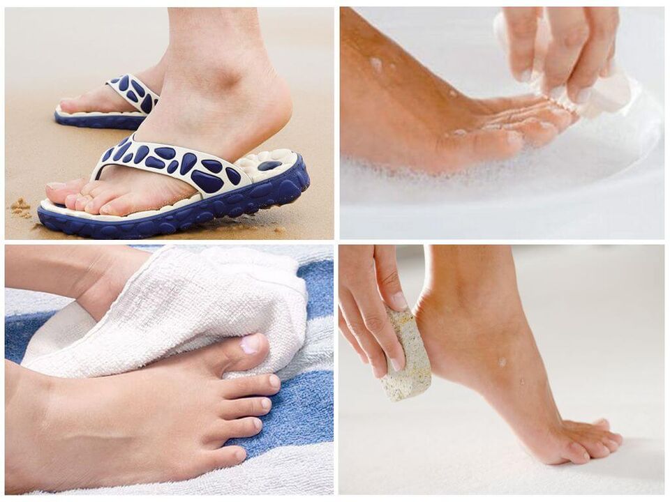 A prevención da onicomicose inclúe a hixiene dos pés, o uso de artigos persoais e pedicuras oportunas