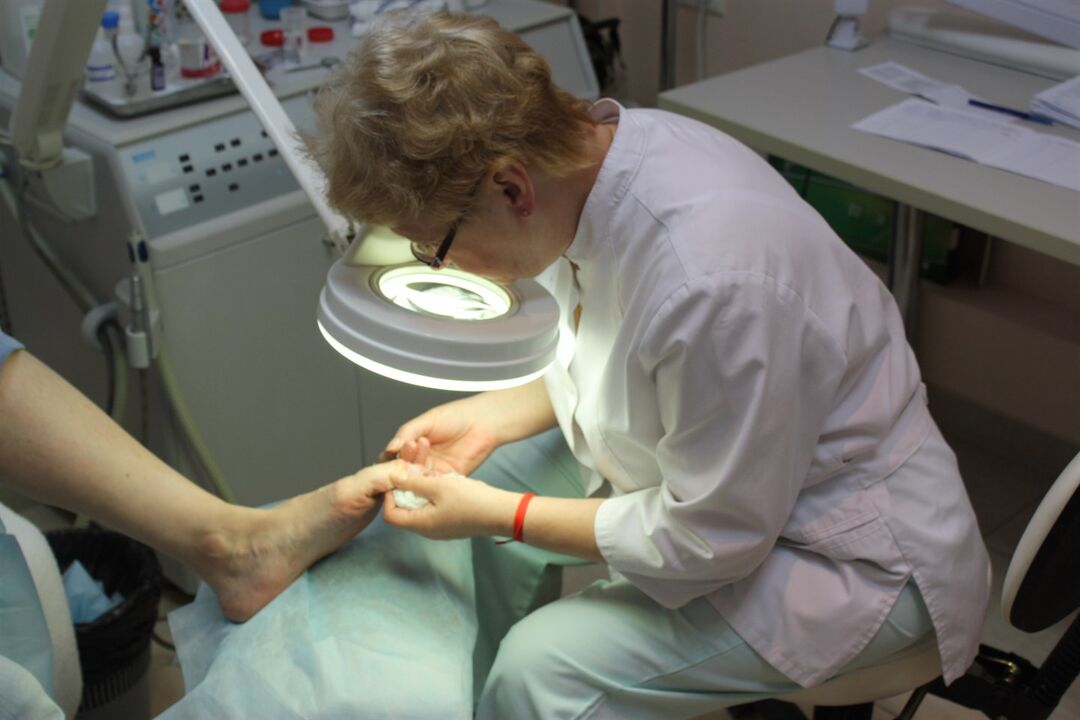 O impresionante desenvolvemento do fungo das unhas dos pés require a axuda dun cirurxián