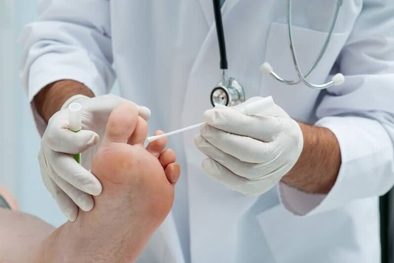 Se tes síntomas de fungo na unha do pé, debes consultar a un dermatólogo ou micólogo. 