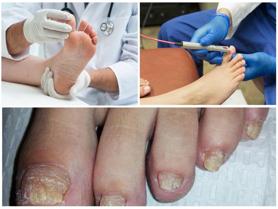 Un médico diagnostica e trata as unhas dos pés afectadas por unha infección por fungos. 