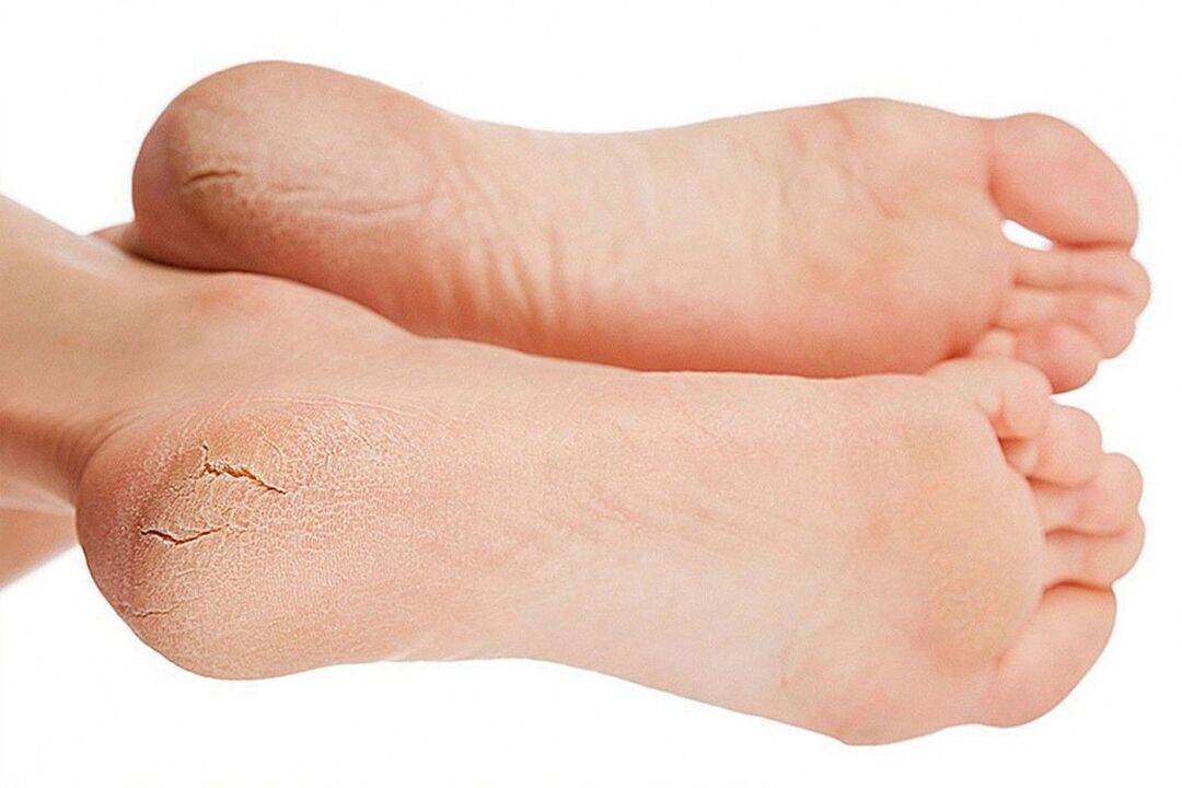 infección fúngica dos pés