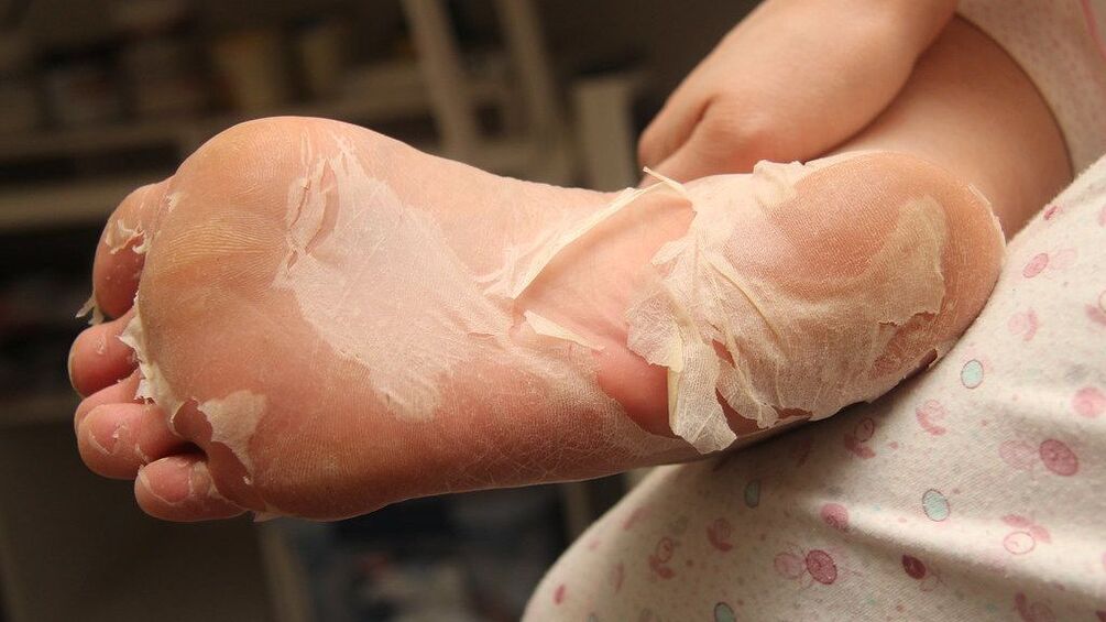infección fúngica grave do pé